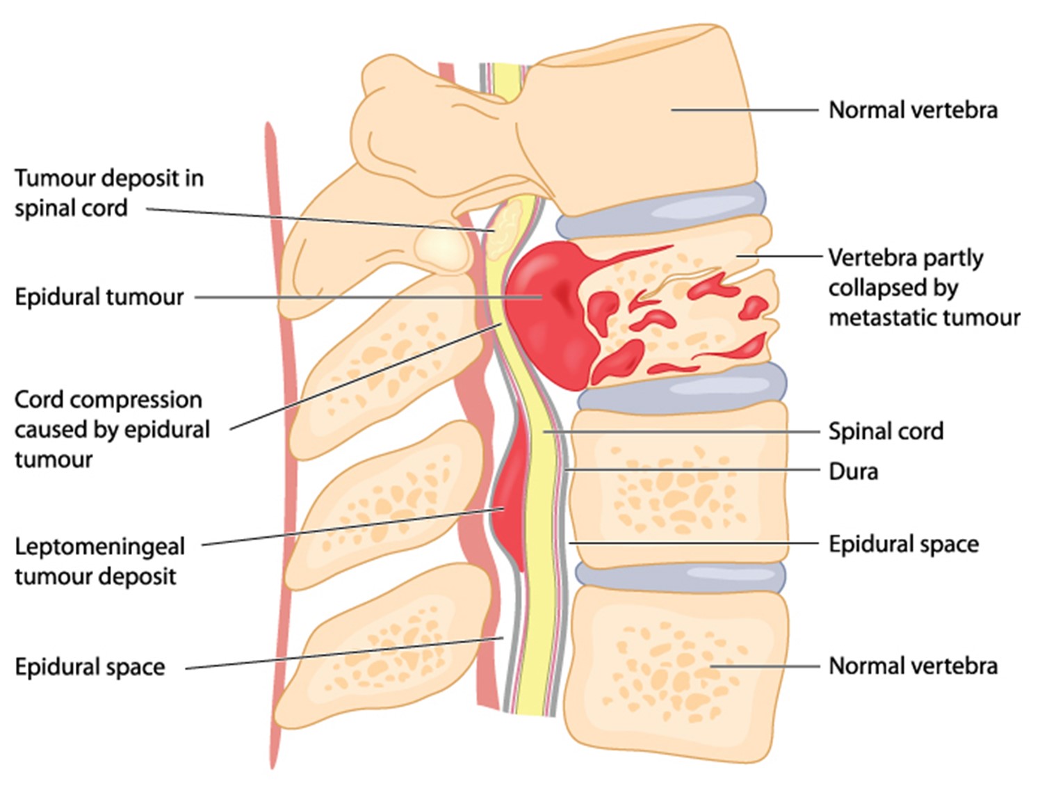 The image represents the location of spinal cord tumors within the vertebrae and spinal cord.